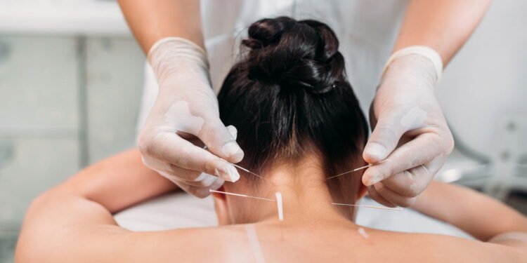 Acupuntura pode desencadear a liberação de endorfinas, substâncias naturais que funcionam como analgésicos - depositphotos.com / VitalikRadko