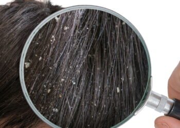 Pare de sofrer: Os segredos para acabar com a caspa de uma vez por todas