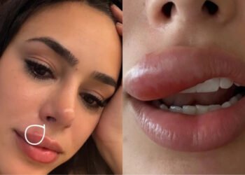 Celulite facial: o problema que atingiu Bruna Biancardi e pode afetar qualquer pessoa