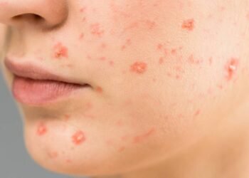 Acne