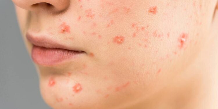 Acne