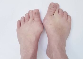 Joanetes: o inimigo silencioso que pode deformar seus pés; saiba como prevenir