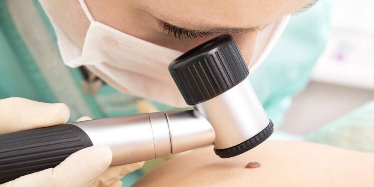 Inteligência Artificial detecta câncer de pele agressivo com 94,5% de precisão