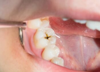 5 hábitos diários que aumentam o risco de cáries sem você saber