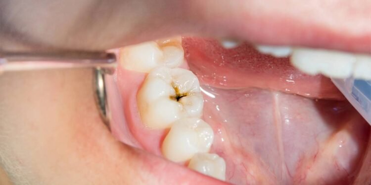 5 hábitos diários que aumentam o risco de cáries sem você saber