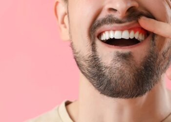 Sangue na escova de dente e ao cuspir? Cuidado, pode ser gengivite!