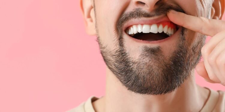 Sangue na escova de dente e ao cuspir? Cuidado, pode ser gengivite!