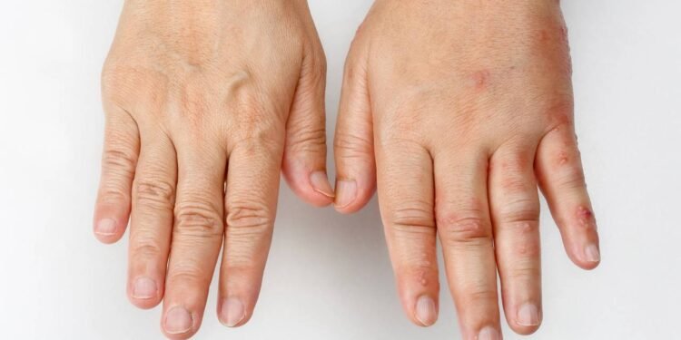 Retenção de líquido: entenda as causas e como tratar