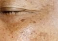 Sofre com manchas no rosto? Saiba como tratar o melasma