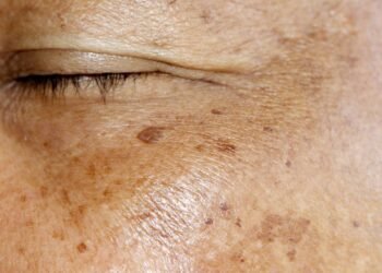 Sofre com manchas no rosto? Saiba como tratar o melasma