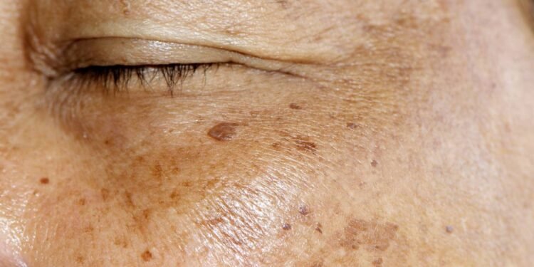 Sofre com manchas no rosto? Saiba como tratar o melasma