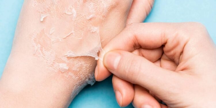 Queimadura e pele descascando pós sol: saiba como tratar