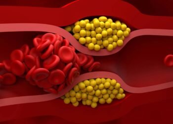 Saiba quais exercícios são essenciais para reduzir gordura nas artérias