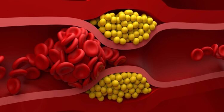 Saiba quais exercícios são essenciais para reduzir gordura nas artérias