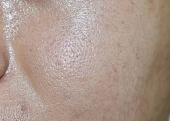 Pele oleosa? Aprenda rotina ideal e conheça os melhores produtos