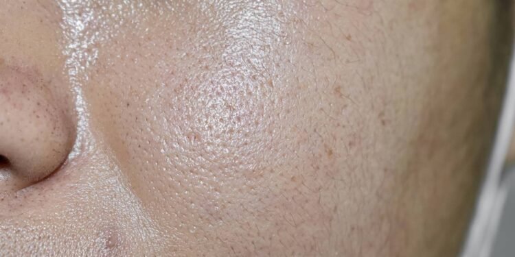 Pele oleosa? Aprenda rotina ideal e conheça os melhores produtos