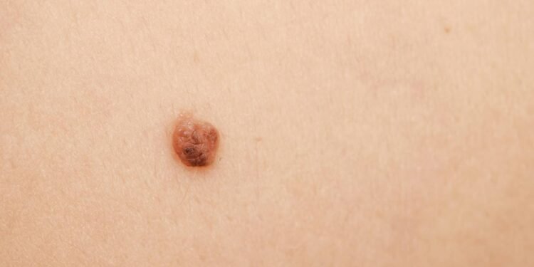 Sintomas do câncer de pele que exigem atenção e não podem ser ignorados