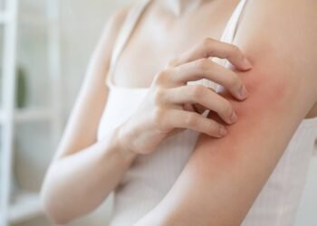 Estresse pode agravar crises de dermatite atópica? Descubra!