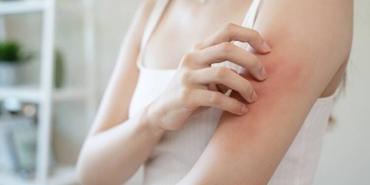 Estresse pode agravar crises de dermatite atópica? Descubra!