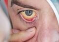 Olhos amarelados: condição alerta para doenças graves