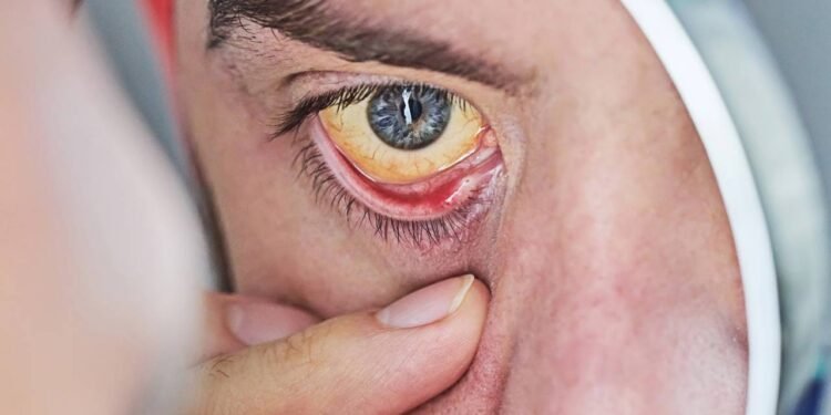Olhos amarelados: condição alerta para doenças graves