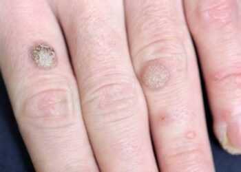 Tipos de verruga: saiba quando pode ser perigoso e tratamento correto