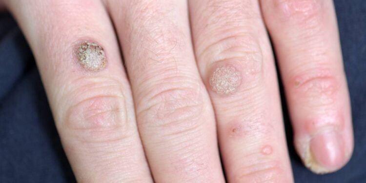 Tipos de verruga: saiba quando pode ser perigoso e tratamento correto