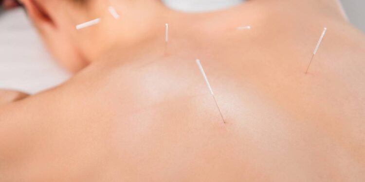 Acupuntura ajuda a controlar a fome: mito ou verdade?