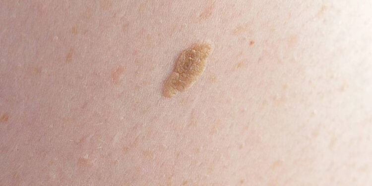 Ceratose actínica: entenda o que é a lesão de pele tratada por Lula