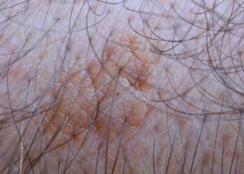 5 tratamentos comuns para a ceratose actínica: de cremes a laser