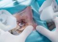 Cirurgia a laser nos olhos: quando é indicada e quanto custa o procedimento