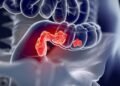 Câncer de intestino: 5 alimentos que aumentam o risco