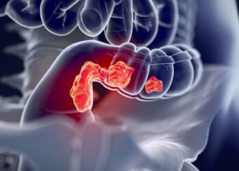 Câncer de intestino: 5 alimentos que aumentam o risco