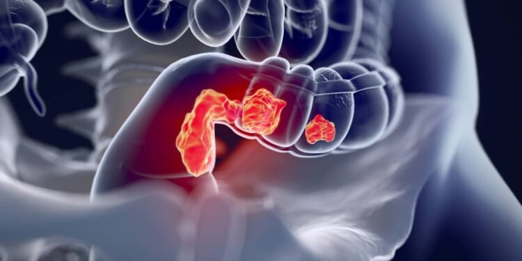 Câncer de intestino: 5 alimentos que aumentam o risco