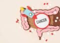 Como funciona o tratamento contra o câncer de intestino