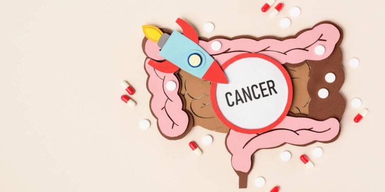 Como funciona o tratamento contra o câncer de intestino