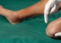 As principais causas de amputação no Brasil e como é possível prevenir
