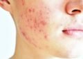 Acne adulta: 5 erros na sua rotina de skincare que podem piorar a espinha