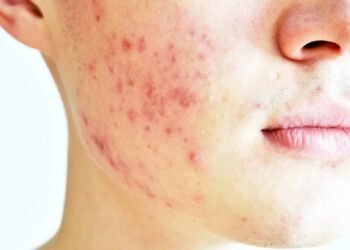 Acne adulta: 5 erros na sua rotina de skincare que podem piorar a espinha