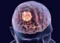 Câncer cerebral: conheça os sintomas e os sinais de alerta