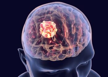 Câncer cerebral: conheça os sintomas e os sinais de alerta