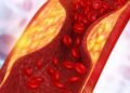 Inibidores de PCSK9: como funciona novo remédio para o colesterol