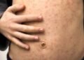 Sarampo em adultos: os sintomas são diferentes e podem ser mais graves