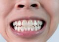 Por que o flúor na água é obrigatório e como ele protege os dentes