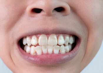 Por que o flúor na água é obrigatório e como ele protege os dentes