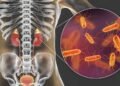 7 sinais de que sua infecção urinária pode estar nos rins