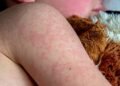 Dose zero do sarampo: quando o bebê precisa tomar a vacina