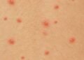 Como o vírus da catapora exige vacina contra herpes zoster