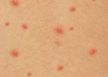 Como o vírus da catapora exige vacina contra herpes zoster