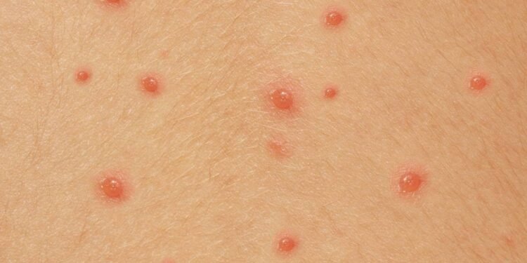 Como o vírus da catapora exige vacina contra herpes zoster